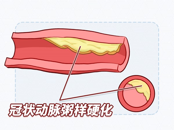 冠心病是怎么形成的?治疗方法有哪些?