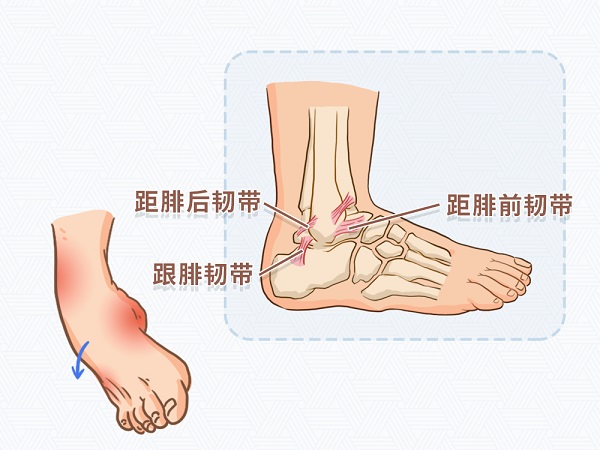 崴脚后怎么紧急处理？有必要去医院吗？.jpg